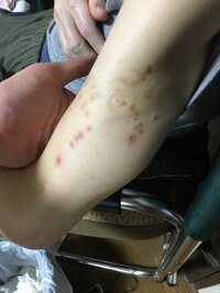 祖父の腕70歳の祖父の腕や 肩 背中 足にこのような湿疹が多々あります 皮膚科 Yahoo 知恵袋