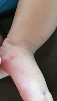 生後2ヵ月の息子の足にニキビみたいのがポツポツと数個出来ていました これゎ乳児 Yahoo 知恵袋