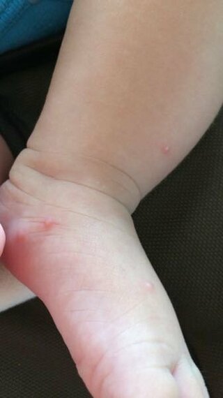 最も共有された ダニ 赤ちゃん 湿疹 足 赤ちゃんの画像は無料