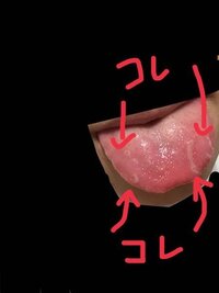 質問お願いします 画像にupしてるのですが舌に白い線が出来てま Yahoo 知恵袋