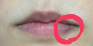 唇のふちが一部のみ紫のような色に変色してから１年が経ちます自然と治るものかと思 Yahoo 知恵袋