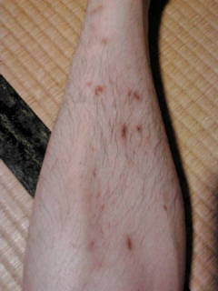 ノミ に 刺され たら 写真 虫さされチェック