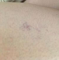 足 太ももに血管が透けて見えてます 青タンかと思ったら血管が浮 Yahoo 知恵袋