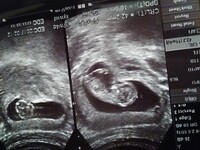 妊娠11週です エコー画像について教え下さい 今日検診に行ってきたん Yahoo 知恵袋