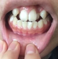 画像あり 歯茎が痩せてしまいました 原因は多分 歯磨きだと思います 画像の通 Yahoo 知恵袋