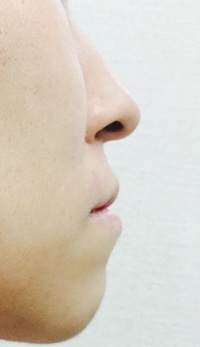 不快な画像申し訳ございません これはアデノイド顔貌というものでしょうか 昔から Yahoo 知恵袋