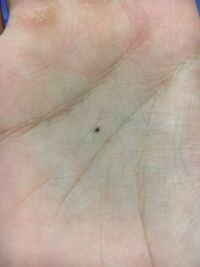 半年ちょっと前から急に手のひらにホクロらしきものが出来始めました 自分は Yahoo 知恵袋