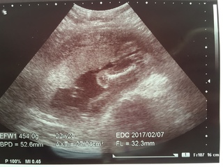 妊娠6ヶ月のエコー写真です 大腿骨のあたりだと先生から説明を受けましたがよくわ Yahoo 知恵袋
