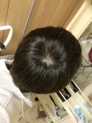 10代後半なんですが つむじがハゲてきたと思って困ってます 髪は短い Yahoo 知恵袋