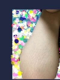 彼女の太ももに肉割れがあったら引きますか 普段は分からない位置なんです Yahoo 知恵袋