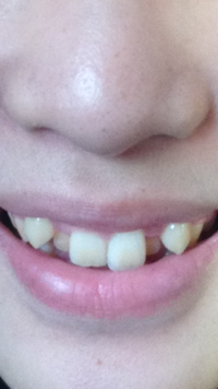 歯並びが悪すぎて笑顔に自信がありません 今 就活中でやはり第一印象が Yahoo 知恵袋