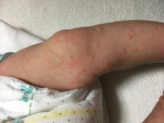 やる 赤ちゃん メンタリティ 赤ちゃん 腕 湿疹 赤い Opensesame246 Jp やる 赤ちゃん メンタリティ 赤ちゃん 腕 湿疹 赤い Opensesame246 Jp