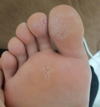 写真のように足の裏の皮膚が剥けていました 気付いたのは最近でいつからなの Yahoo 知恵袋
