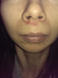 顔の傷跡を消したいです 今はケロコートを塗ってます 乾燥からは防げてて日 Yahoo 知恵袋