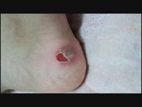 スケート靴で子供が靴擦れをおこしてしまいます 予防する方法はありますか ち Yahoo 知恵袋