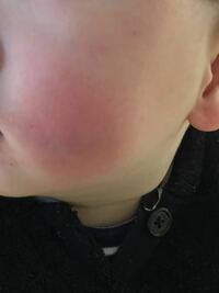 先ほど1歳4ヶ月の息子が テーブルに顔をぶつけてしまい あごをぶつけたので Yahoo 知恵袋