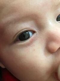 生後3ヶ月の息子がいます 片目に赤いブツブツが出ていて痒そうしていま Yahoo 知恵袋