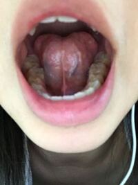 僕は舌小帯短縮症なのですが 彼女とのディープキスがうまく行きません Yahoo 知恵袋