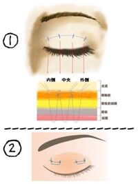 二重埋没について 共立美容外科は挙筋法で 大塚美容外科は瞼板法とかい Yahoo 知恵袋