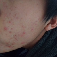 男子高校生です 頬にニキビができてなかなか無くならないので困っており Yahoo 知恵袋