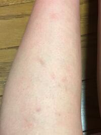 こんな足の傷跡ってもう一生消えませんか この傷ができてから大体1年弱くら Yahoo 知恵袋