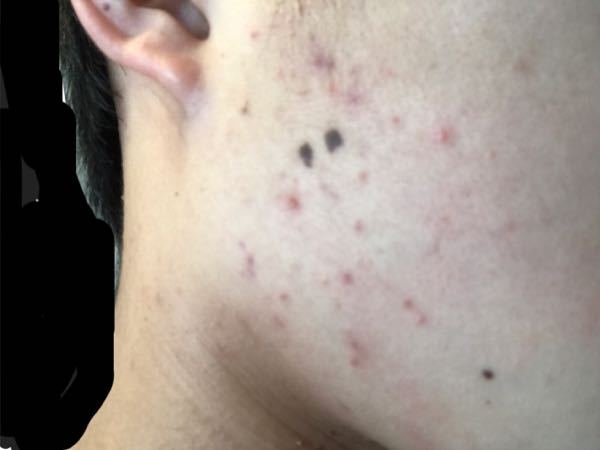 ニキビと肌荒れの違いがわかりません これはニキビですか 肌荒れですか Yahoo 知恵袋