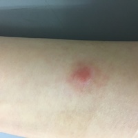 数ヶ月前にイボコロリを使ってイボを取りました直径8mm 厚さ2mmほ Yahoo 知恵袋