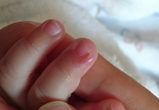 生後5ヵ月の乳児の爪囲炎 ひょうそう についてです 3日前から添付写真の Yahoo 知恵袋