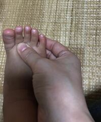 １歳10ヶ月の子供の足の小指が曲がっています 靴が合ってないせいでこうなったの Yahoo 知恵袋