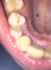 どなかた教えて下さい 先ほど歯を磨いていたら上顎に黒い点を見つけました ネッ Yahoo 知恵袋