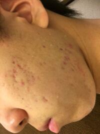 このニキビ跡は何日くらいでマシになりそうですか また 日焼けで Yahoo 知恵袋