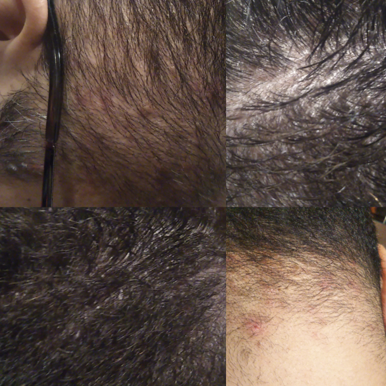 もみあげ フケ に関するq A Yahoo 知恵袋