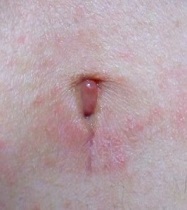 6週間前に腹腔鏡で虫垂炎の手術をしました その後 粘膜状のようなもの Yahoo 知恵袋