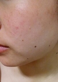 肌荒れ頬の赤み ただれ24歳女性上記の悩みについて写真を添付しました Yahoo 知恵袋