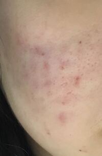 城本クリニックでフォトフェイシャルを考えています 私はニキビ跡がひどく皮 Yahoo 知恵袋