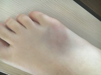 部活で足の甲をスパイクで踏まれたのですが 今までこんなに腫れたことは初めてです Yahoo 知恵袋