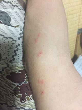 疱疹 初期 帯状