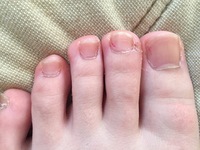 爪周りの皮がカチカチボロボロです 改善する何かいい方法はありますか きった Yahoo 知恵袋