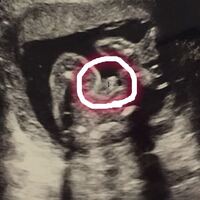 妊娠22週です W 逆子で見えずらいとのことでしたが男の子と思ってい Yahoo 知恵袋