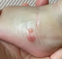 9ヶ月の赤ちゃんこれはダニの跡ですか 2日前から2箇所ポツとなっていま Yahoo 知恵袋