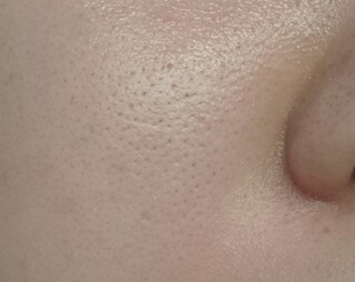 頬の黒いブツブツについて 二十歳の女です 画像の通り頬に黒いブツブツ Yahoo 知恵袋