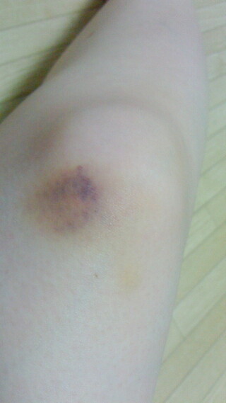 打撲について 画像あり ５日前に足をぶつけてしまいました 腫れてなかったので放 Yahoo 知恵袋