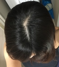 これは髪が薄いというのでしょうか どこで分けても このように生え際 Yahoo Beauty