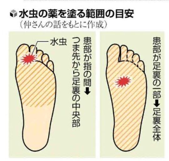 水虫 解決済みの質問 Yahoo 知恵袋