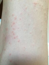 点々 ない 赤い 太もも かゆく 皮膚の赤い斑点は病気？かゆみがあるなしでの７つの原因と対処法！