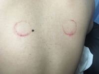 背中に赤い丸の様な跡が付いてました 何かの病気でしょうか 病的 Yahoo 知恵袋