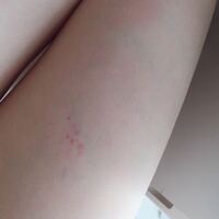今朝 太ももに赤い斑点が出ていることに気付きました 19歳 女性です 体の他の Yahoo 知恵袋