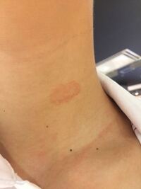 汗をたくさんかいたら首が痒くなって力いっぱいかいてしまい 首 Yahoo 知恵袋