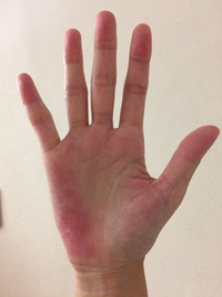 手のひらが赤いのですが手掌紅斑 というやつでしょうか 痒みと痛みはあ Yahoo 知恵袋