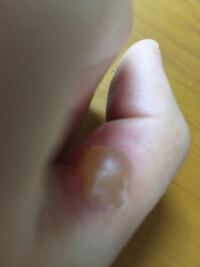 写真あり水ぶくれについて質問です 4日前 ほうきで力を入れすぎて掃除したとこ Yahoo 知恵袋